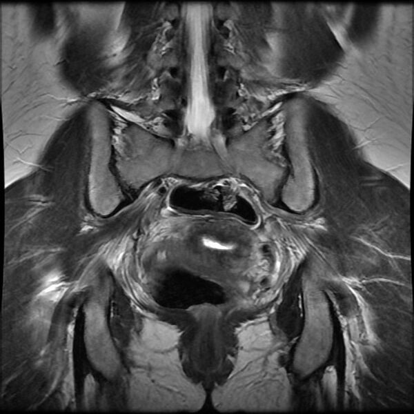 File:Adenomyosis on MRI (Radiopaedia 29328-29780 Coronal T2 4).jpg