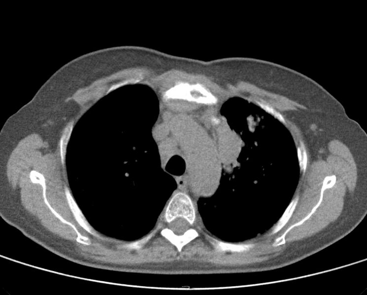 File:Adenosquamous lung carcinoma (Radiopaedia 22035-22030 non-contrast 23).jpg