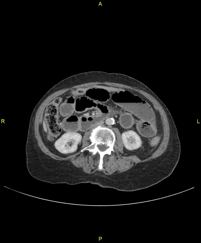 Adhesional small bowel obstruction (Radiopaedia 85402-101024 Axial C+ portal venous phase 136).jpg