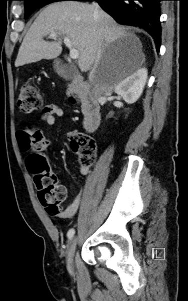 File:Adrenal lymphoma (Radiopaedia 73730-84529 Sagittal C+ portal venous phase 40).jpg