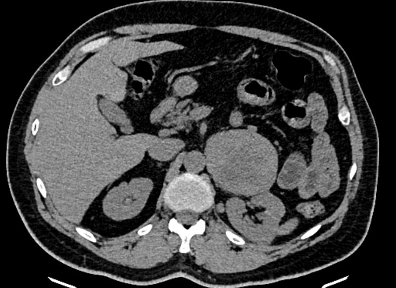 File:Adrenal metastases (Radiopaedia 73082-83791 Axial non-contrast 58).jpg
