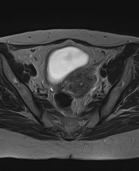 File:Adult granulosa cell tumor of the ovary (Radiopaedia 71581-81950 Axial T2 13).jpg