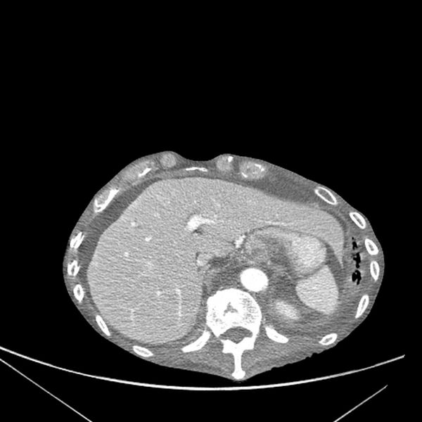 File:Advanced pulmonary tuberculosis (Radiopaedia 8599-9431 Axial liver window 18).jpg