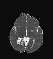 Aicardi syndrome (Radiopaedia 66029-75205 Axial ADC 11).jpg