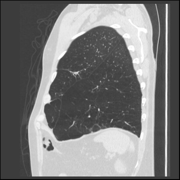 File:Alpha-1-antitrypsin deficiency (Radiopaedia 40993-43722 Sagittal lung window 49).jpg