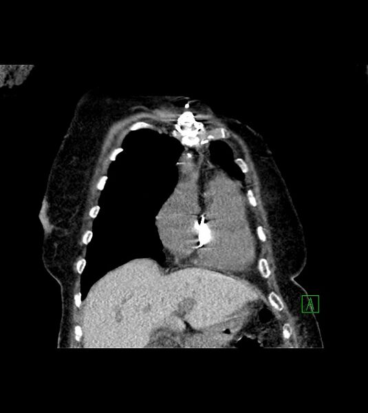 File:Amiodarone deposition in the liver (Radiopaedia 77587-89780 Coronal non-contrast 22).jpg