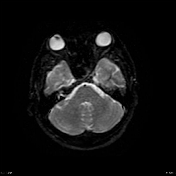 File:Amnestic syndrome secondary to hypoxic brain injury (Radiopaedia 24743-25004 DWI 41).jpg