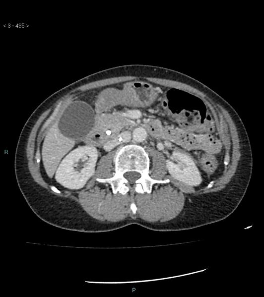 File:Ampulla of Vater metastasis (Radiopaedia 27820-28069 A 73).jpg