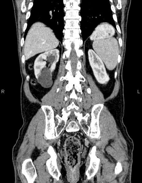 File:Ampullary adenocarcinoma (Radiopaedia 86093-102032 C 52).jpg