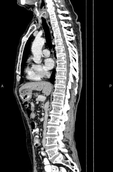 File:Ampullary adenocarcinoma (Radiopaedia 86093-102033 E 44).jpg