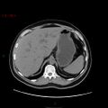 Ampullary carcinoma (Radiopaedia 56396-63056 Axial non-contrast 12).jpg