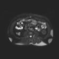 Ampullary tumor (Radiopaedia 27294-27479 T2 SPAIR 1).jpg