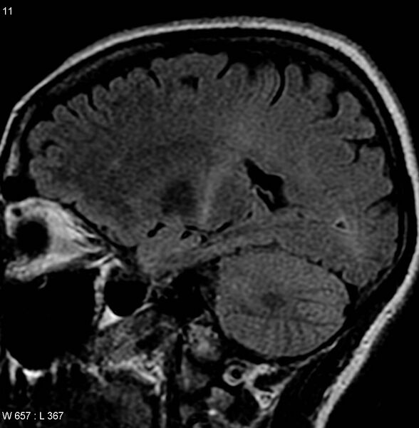 File:Amyotrophic lateral sclerosis (Radiopaedia 4719-6744 Sagittal FLAIR 1).jpg