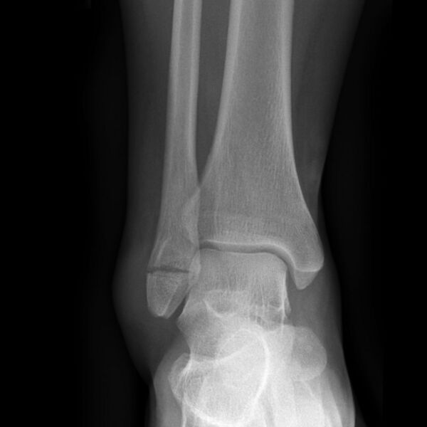 File:Ankle fracture - Weber A (Radiopaedia 7965-8811 Frontal 1).jpg