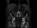 Ankylosing spondylitis (Radiopaedia 44609-48357 Coronal bone window 45).jpg