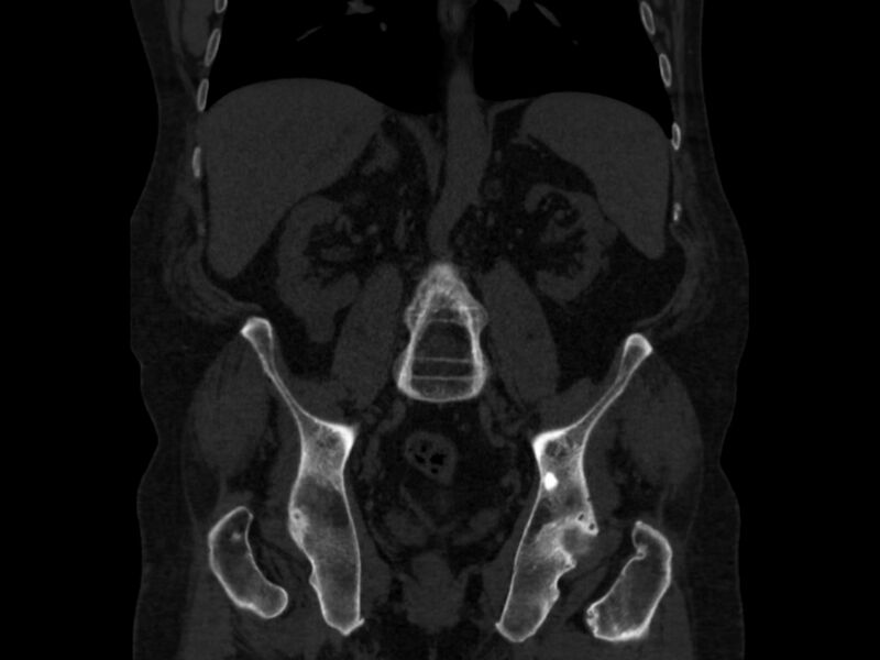 File:Ankylosing spondylitis (Radiopaedia 44609-48357 Coronal bone window 45).jpg