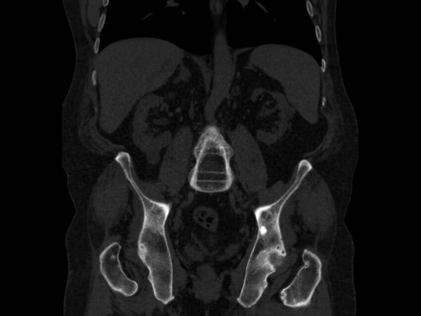 Ankylosing spondylitis (Radiopaedia 44609-48357 Coronal bone window 45).jpg