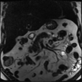 Annular pancreas (Radiopaedia 38292-40320 Coronal T2 20).png