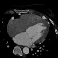 Anomalous left coronary artery from the pulmonary artery (ALCAPA) (Radiopaedia 40884-43586 A 45).jpg