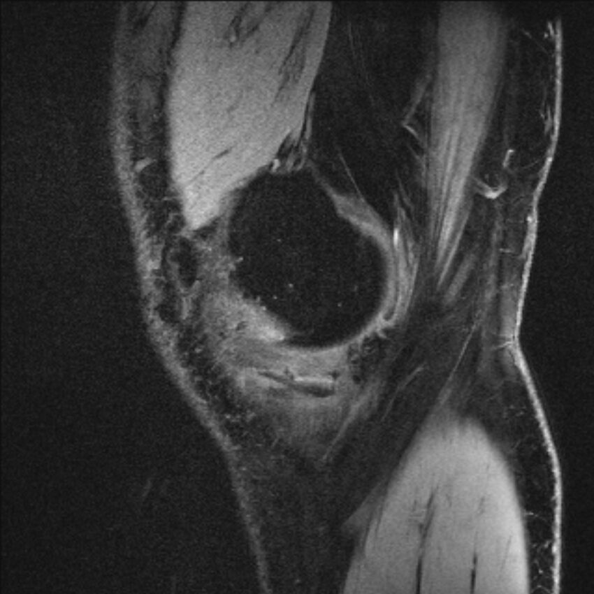 Anterior cruciate ligament mucoid degeneration (Radiopaedia 68400-77933 Sagittal 59).jpg