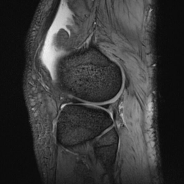 File:Anterior cruciate ligament tear - ramp lesion (Radiopaedia 71883-82322 Sagittal T2 fat sat 6).jpg