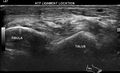 Anterior talofibular ligament injury (Radiopaedia 53338-59320 A 7).jpg