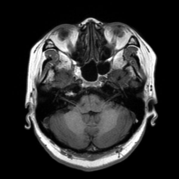 File:Anti-MOG encephalomyelitis (Radiopaedia 73831-84646 Axial T1 13).jpg