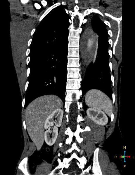File:Aortic aneurysm and penetrating ulcer (Radiopaedia 23590-23704 B 23).jpg