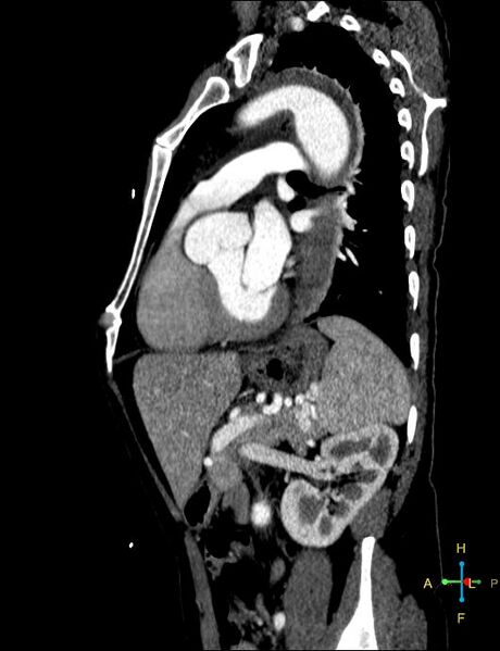 File:Aortic aneurysm and penetrating ulcer (Radiopaedia 23590-23704 C 3).jpg