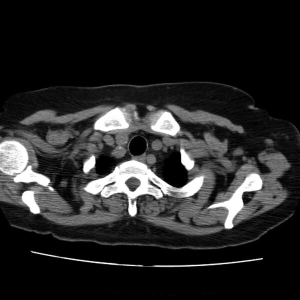 File:Aortic arch pseudoaneurysm (Radiopaedia 8534-9368 Axial non-contrast 3).jpg