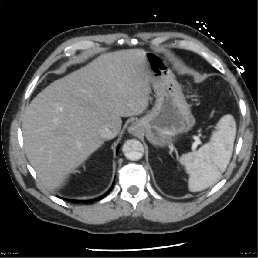 Aortic dissection- Stanford A (Radiopaedia 37759-39664 A 64).jpg