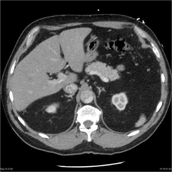 File:Aortic dissection- Stanford A (Radiopaedia 37759-39664 A 74).jpg