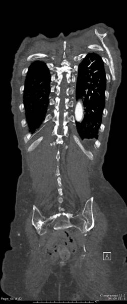 File:Aortic dissection with extension into aortic arch branches (Radiopaedia 64402-73204 A 68).jpg