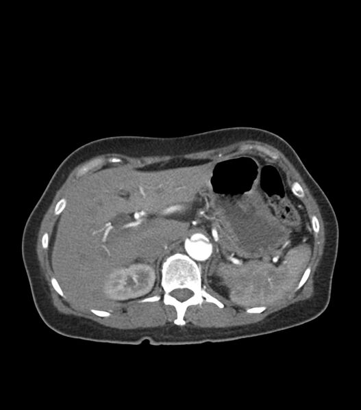 File:Aortic dissection with renal ischemia (Radiopaedia 76573-88338 A 60).jpg