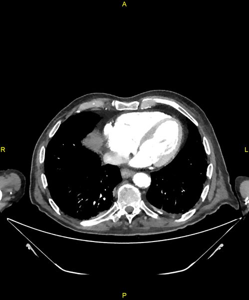 File:Aortoenteric fistula (Radiopaedia 84308-99603 B 1).jpg