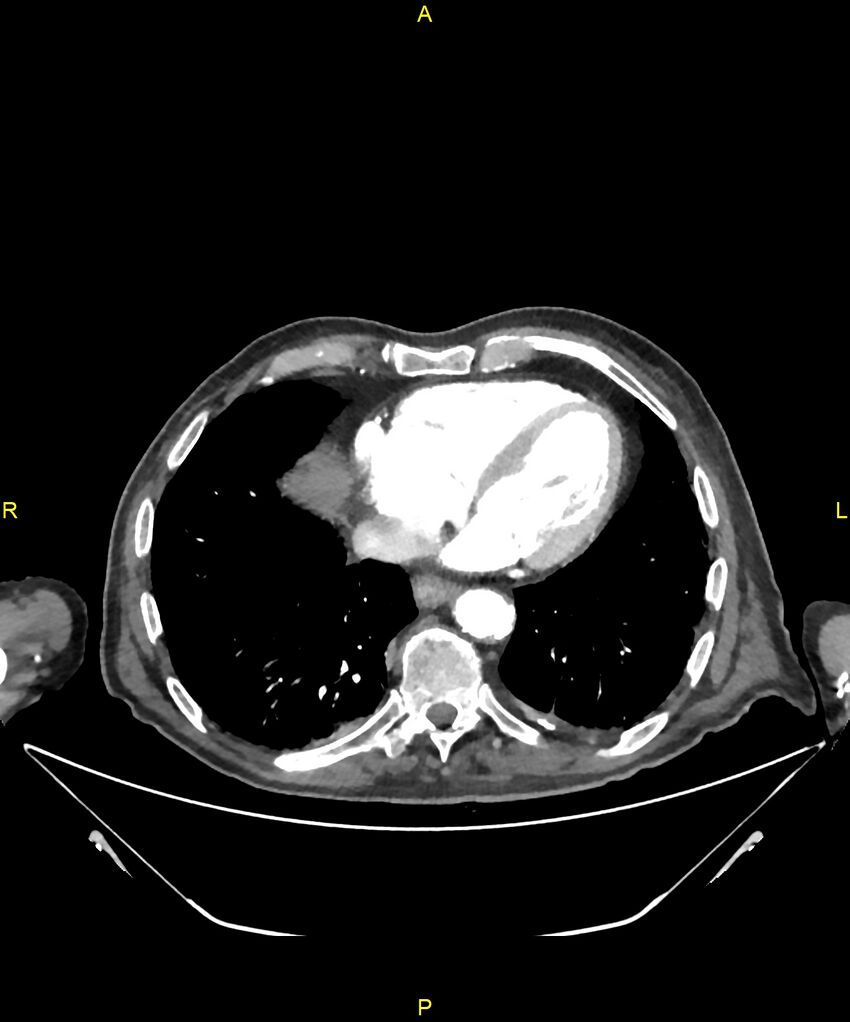 Aortoenteric fistula (Radiopaedia 84308-99603 B 1).jpg