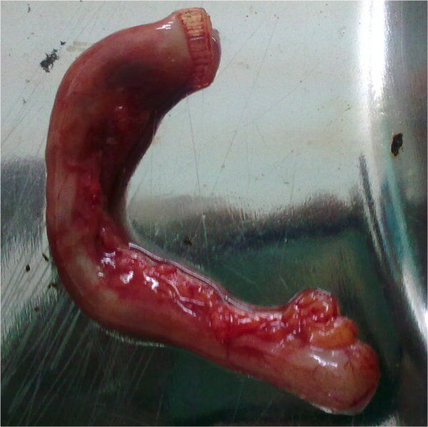 File:Appendicitis (gross pathology) (Radiopaedia 9644).png