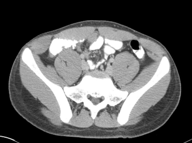File:Appendicitis and incidental foregut duplication cyst (Radiopaedia 52962-58916 A 66).jpg