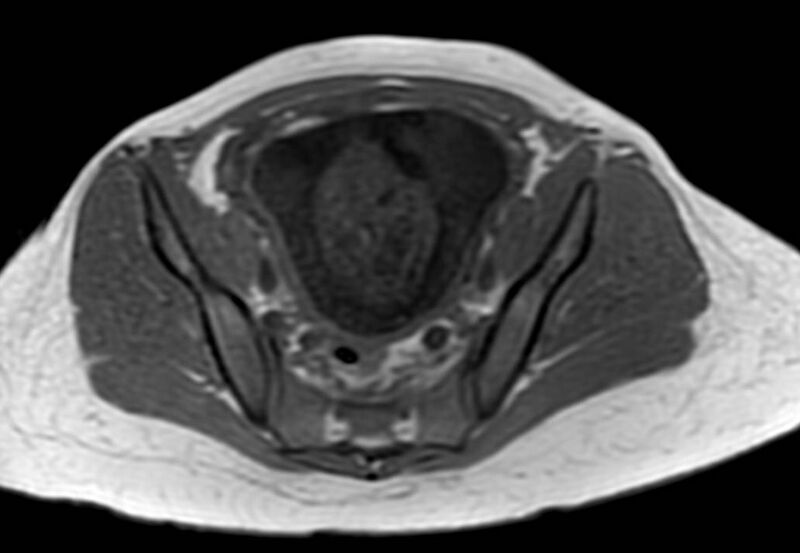 File:Appendicitis in gravida (MRI) (Radiopaedia 89433-106395 Axial T1 in-phase 56).jpg