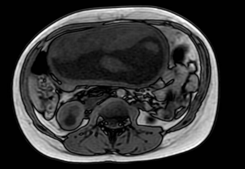 File:Appendicitis in gravida (MRI) (Radiopaedia 89433-106395 D 30).jpg