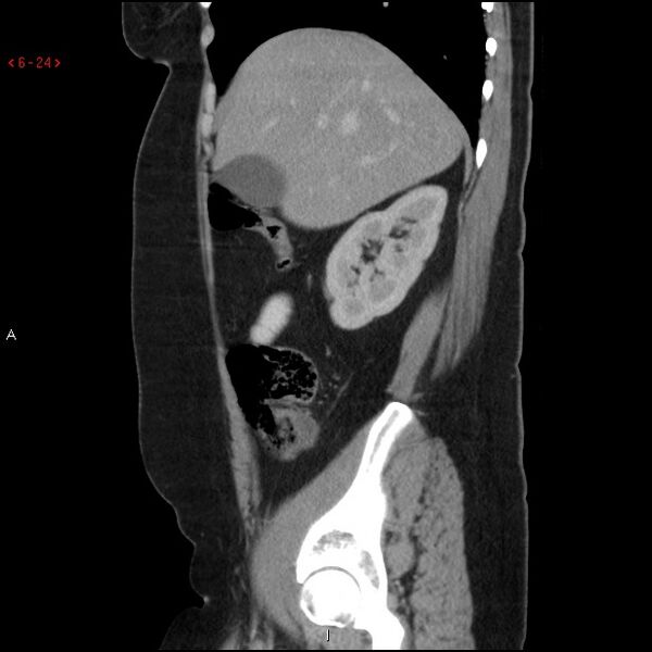 File:Appendicitis with microperforation- promontoric type (Radiopaedia 27268-27442 A 9).jpg