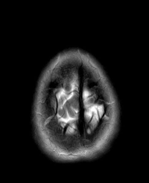 File:Arachnoid cyst- extremely large (Radiopaedia 68741-78451 Axial T2 25).jpg