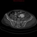 Arachnoiditis ossificans (Radiopaedia 51394-57136 Axial bone window 34).jpg