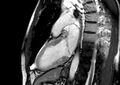 Arrhythmogenic right ventricular cardiomyopathy (Radiopaedia 39806-42237 B 6).jpg