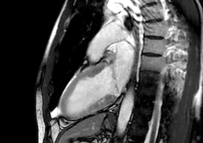 File:Arrhythmogenic right ventricular cardiomyopathy (Radiopaedia 39806-42237 B 6).jpg