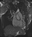 Arrhythmogenic right ventricular cardiomyopathy (Radiopaedia 57972-64966 CINE R2 SSFP 33).jpg