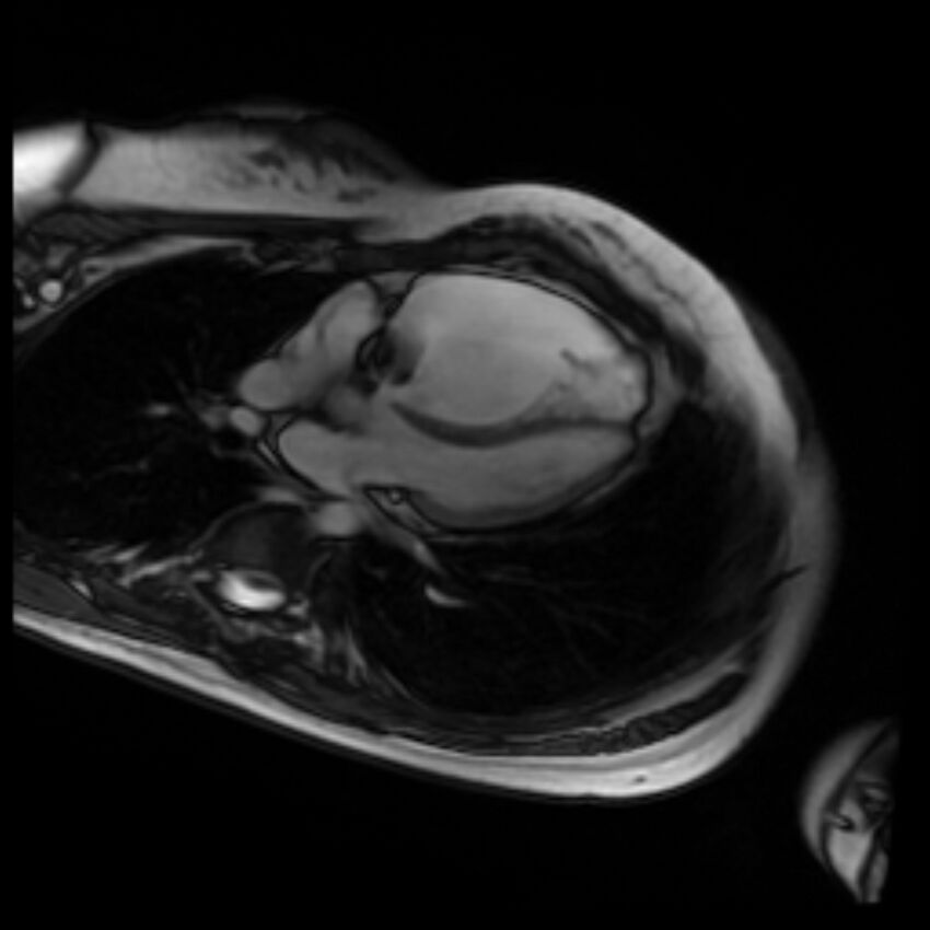 Arrhythmogenic right ventricular cardiomyopathy (Radiopaedia 87505-103850 4ch Cine SSFP 52).jpg