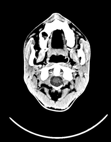 File:Arrow injury to the brain (Radiopaedia 72101-82607 Axial 6).jpg