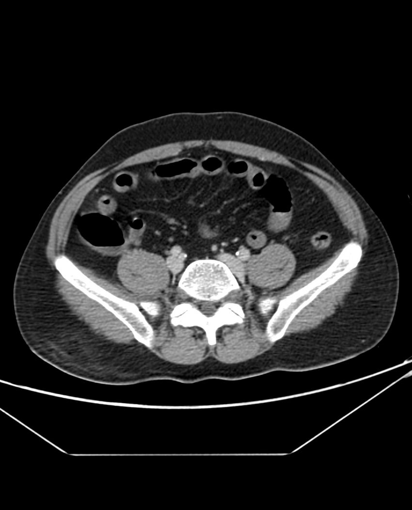 Arterial occlusive mesenteric ischemia (Radiopaedia 84641-100054 A 84).jpg