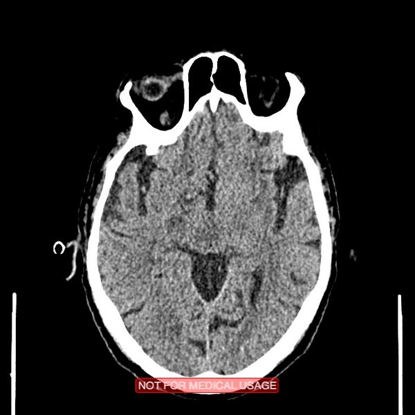 File:Artery of Percheron infarction (Radiopaedia 28679-28967 Axial non-contrast 53).jpg